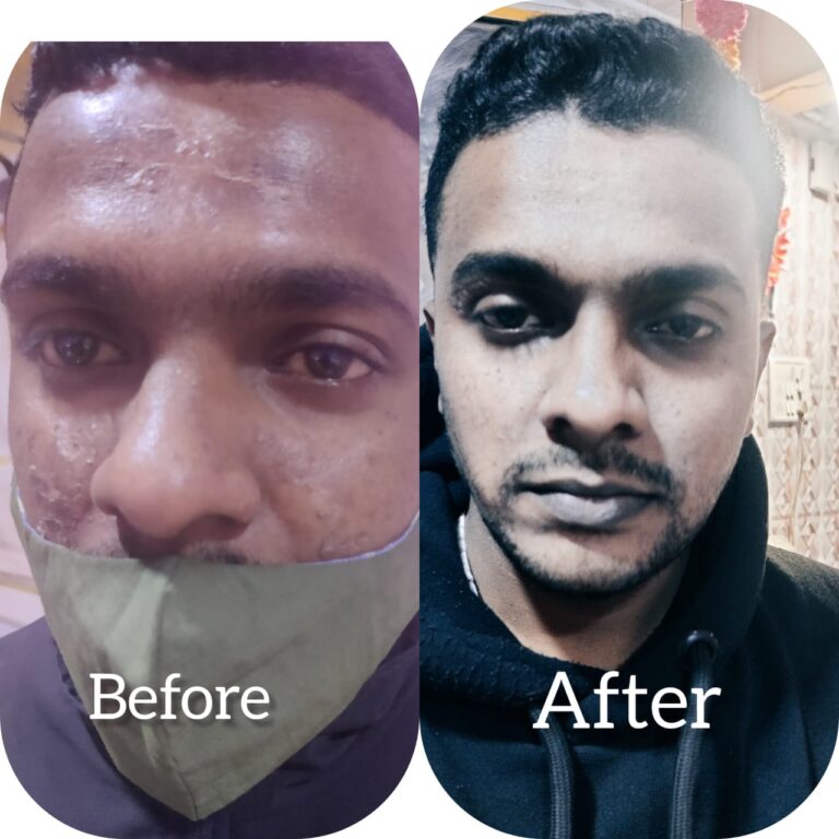 Acne or Pimple Treatment Before & After
