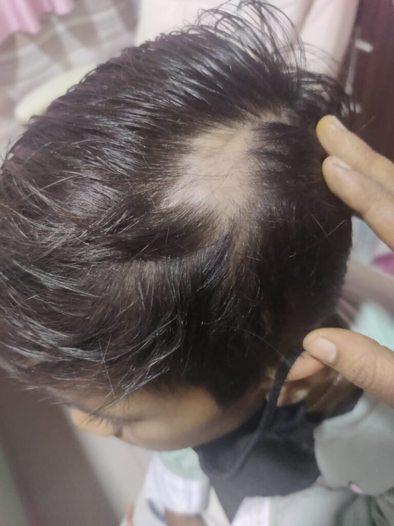 Alopecia Areata Bald Spot