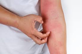 Eczema / Skin Inflammation
