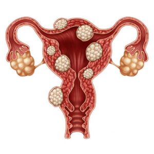 Uterine disorders