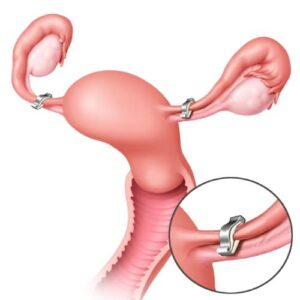 Tubal Ligation