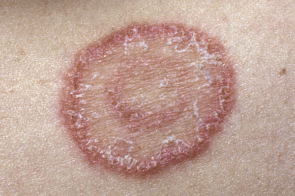 Fungal Ringworm Infection