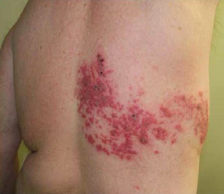 Herpes Zoster Rash