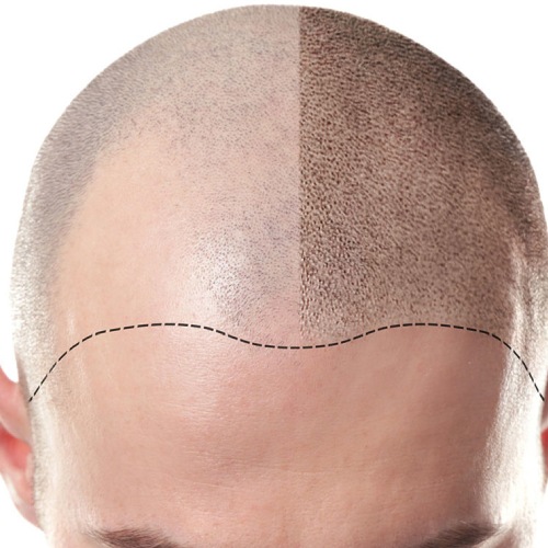Scalp Micro Pigmentation