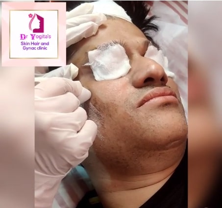 Skin Polishing Treatment