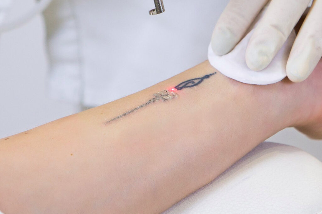 Tatoo Removable