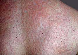 Urticaria / शीतपित्त