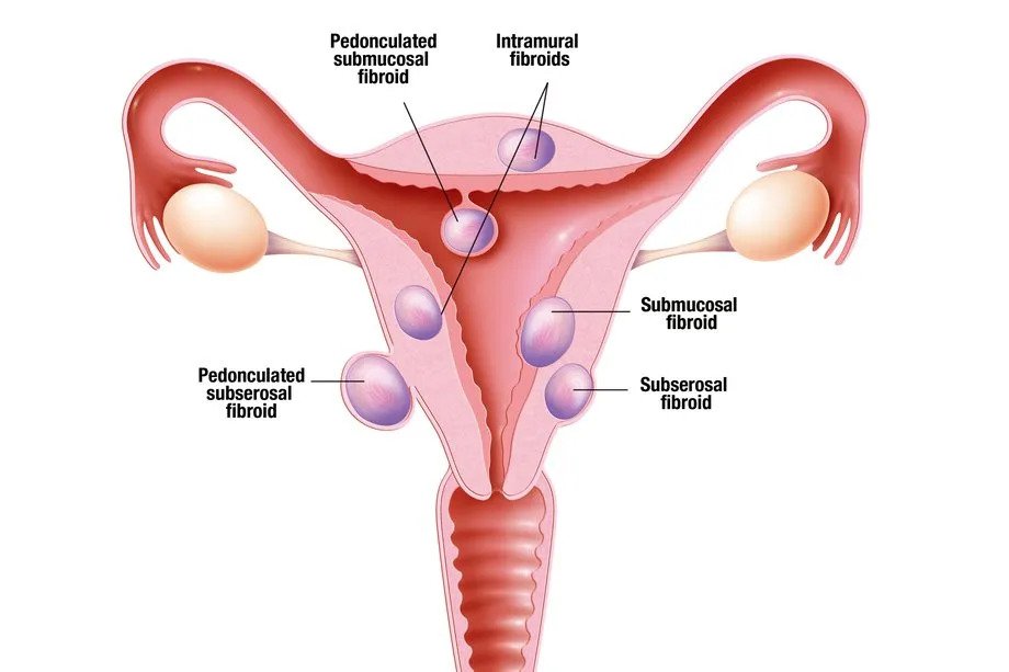 Uterine Problems- fiberoid
