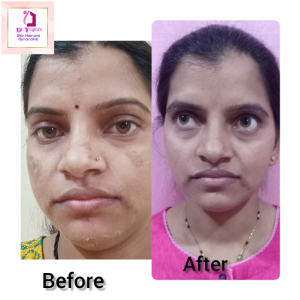 Peeling Treatment