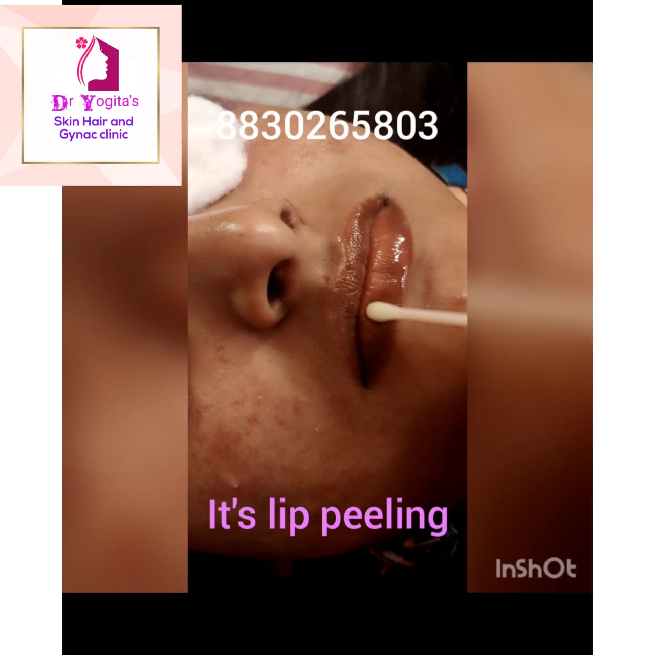 Lip peeling Treatment