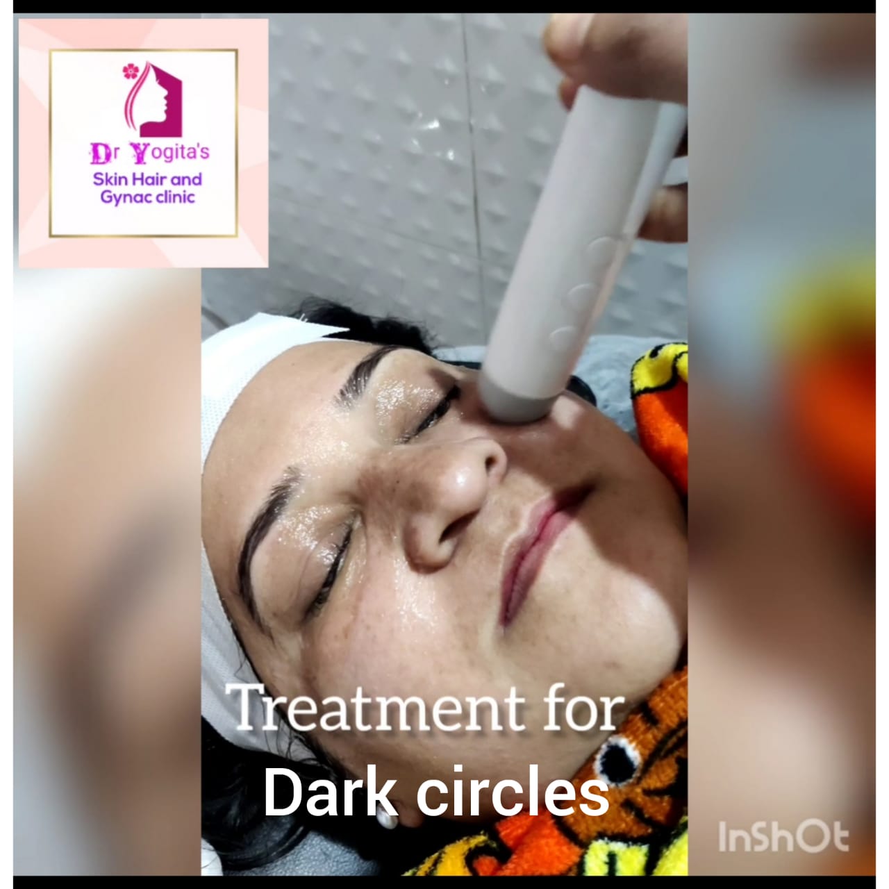 Dark Circle Treatment