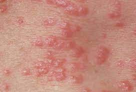 Scabies Skin Rash
