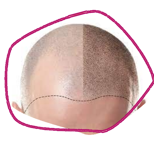 Scalp Micro Pigmentation